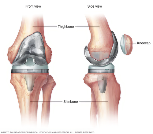 Best Knee Replacement Surgeon Dr. Sumit Dubewar - Secunderabad Orthopedic Expert