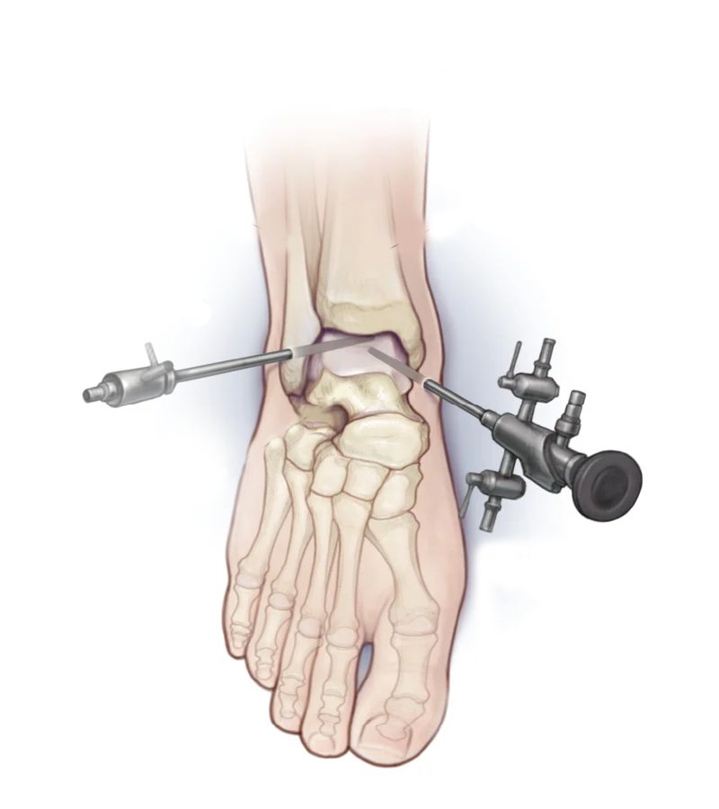 Expert Ankle Arthroscopy Treatment in Secunderabad