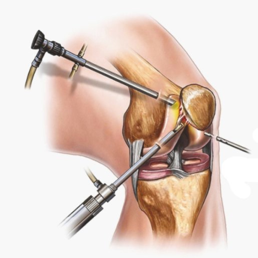 Knee Arthroscopy Procedure Secunderabad Orthopedic Specialist