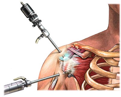 Expert Shoulder Arthroscopy in Secunderabad - Top Orthopedic Doctor