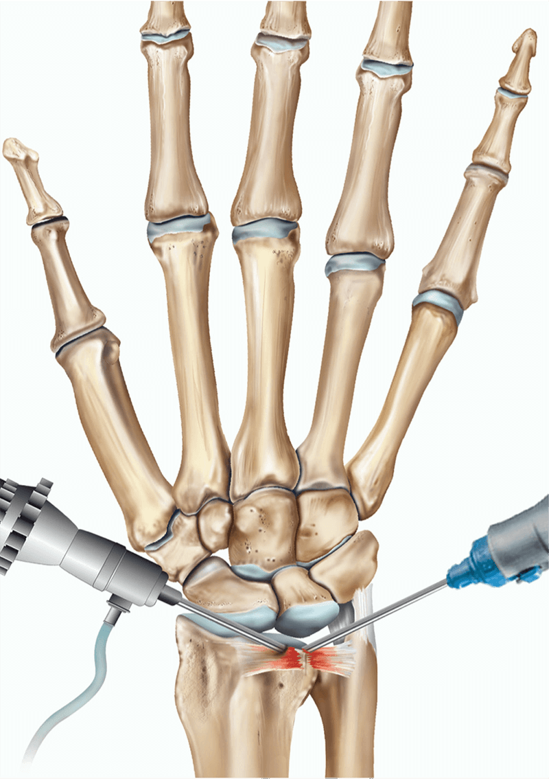 Wrist Arthroscopy procedure by best orthopedic doctor in Secunderabad